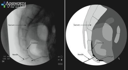 Ganglion impar block
